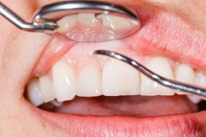 Zahnrenigung und Zahnfleischbluten - dr le Coutre