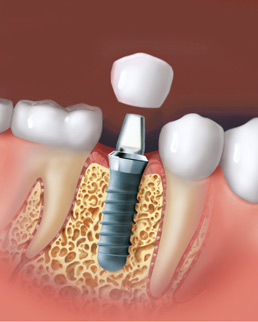 dentale implantate